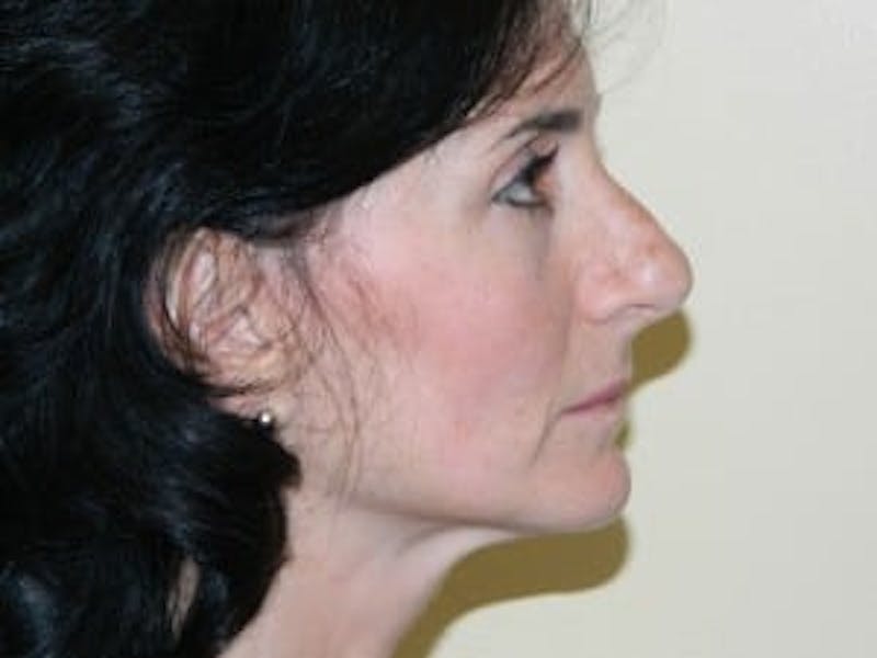 Rhinoplasty Before & After Gallery - Patient 133066756 - Image 1
