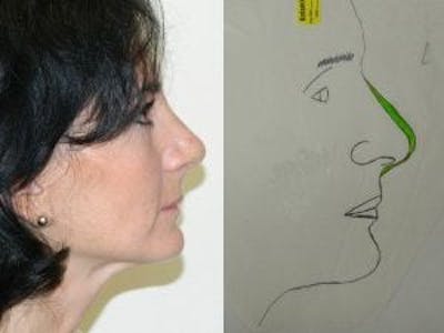 Rhinoplasty Before & After Gallery - Patient 133066756 - Image 2