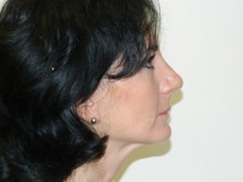 Rhinoplasty Before & After Gallery - Patient 133066756 - Image 4