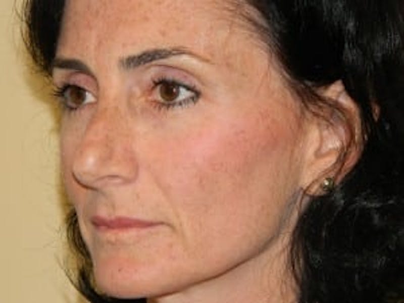 Rhinoplasty Before & After Gallery - Patient 133066756 - Image 5