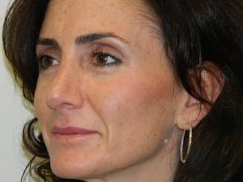 Rhinoplasty Before & After Gallery - Patient 133066756 - Image 6