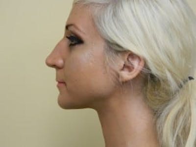 Rhinoplasty Before & After Gallery - Patient 133066757 - Image 1