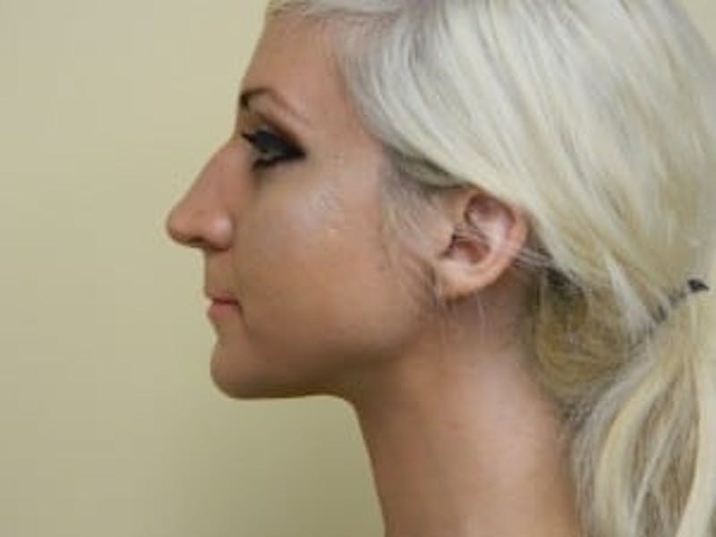 Rhinoplasty Before & After Gallery - Patient 133066757 - Image 1