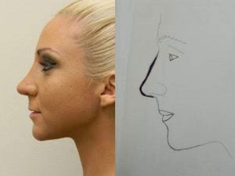 Rhinoplasty Before & After Gallery - Patient 133066757 - Image 2
