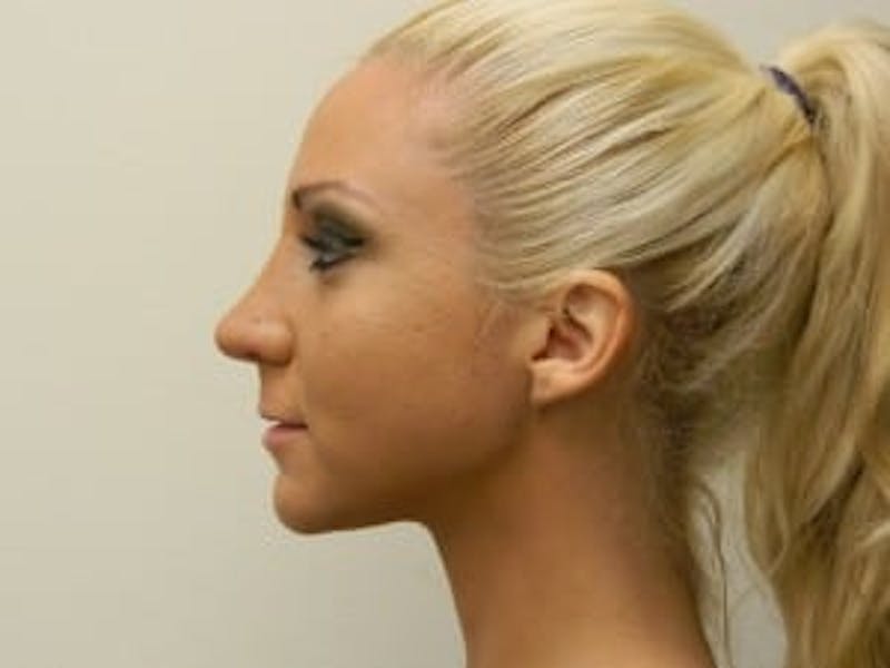 Rhinoplasty Before & After Gallery - Patient 133066757 - Image 4