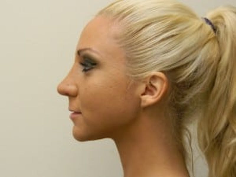 Rhinoplasty Before & After Gallery - Patient 133066757 - Image 4