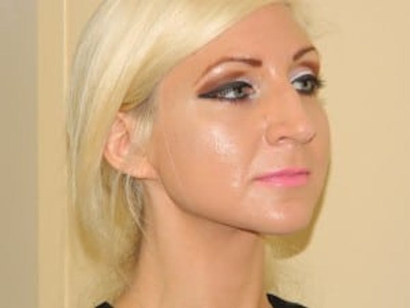 Rhinoplasty Before & After Gallery - Patient 133066757 - Image 5