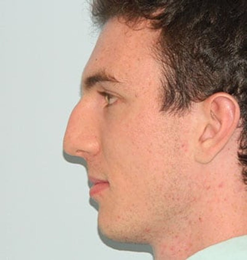 Rhinoplasty Before & After Gallery - Patient 133066758 - Image 1
