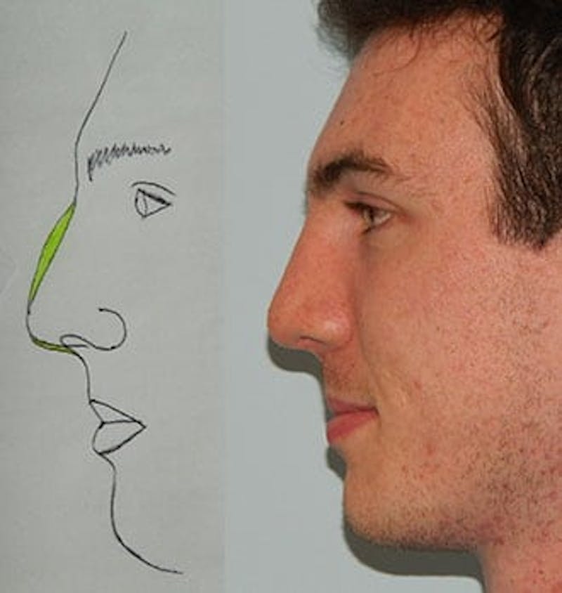 Rhinoplasty Before & After Gallery - Patient 133066758 - Image 2