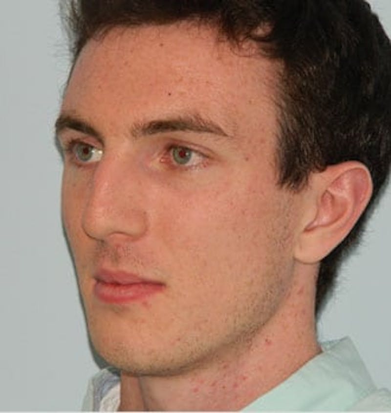 Rhinoplasty Before & After Gallery - Patient 133066758 - Image 3