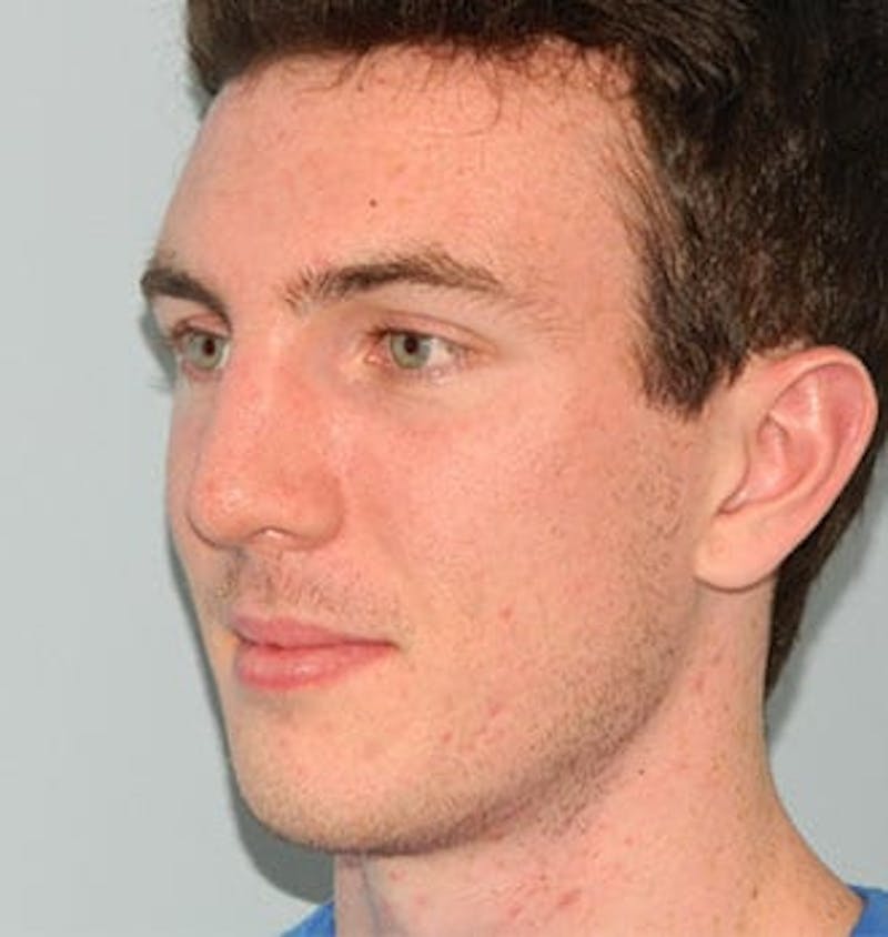 Rhinoplasty Before & After Gallery - Patient 133066758 - Image 4