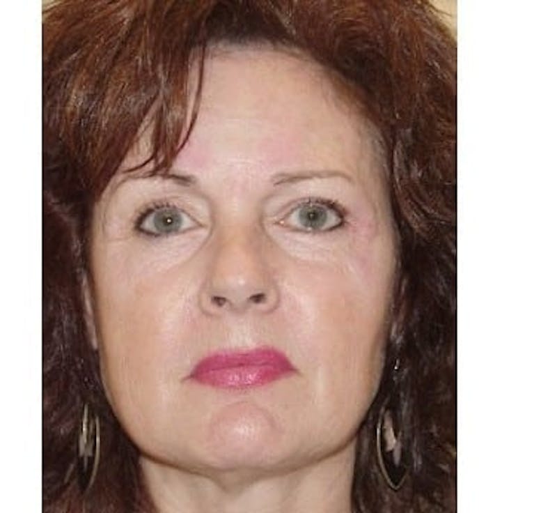 Rhinoplasty Before & After Gallery - Patient 133066759 - Image 1