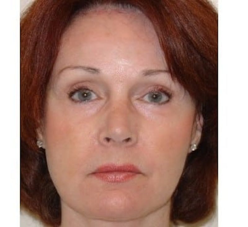 Rhinoplasty Before & After Gallery - Patient 133066759 - Image 2