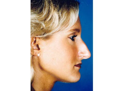 Rhinoplasty Before & After Gallery - Patient 133066760 - Image 1