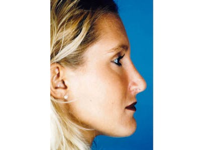 Rhinoplasty Before & After Gallery - Patient 133066760 - Image 2