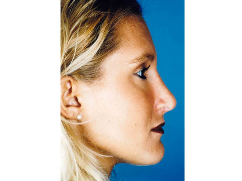 Rhinoplasty Before & After Gallery - Patient 133066760 - Image 2