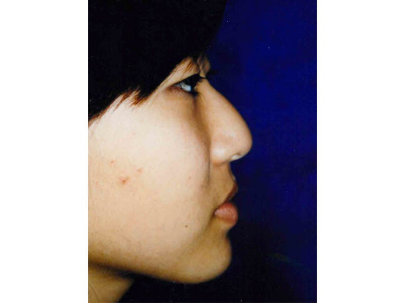 Rhinoplasty Before & After Gallery - Patient 133066761 - Image 1