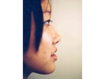Rhinoplasty Before & After Gallery - Patient 133066761 - Image 2