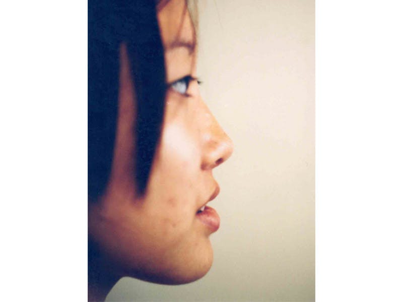 Rhinoplasty Before & After Gallery - Patient 133066761 - Image 2