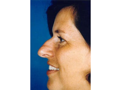 Rhinoplasty Before & After Gallery - Patient 133066762 - Image 1