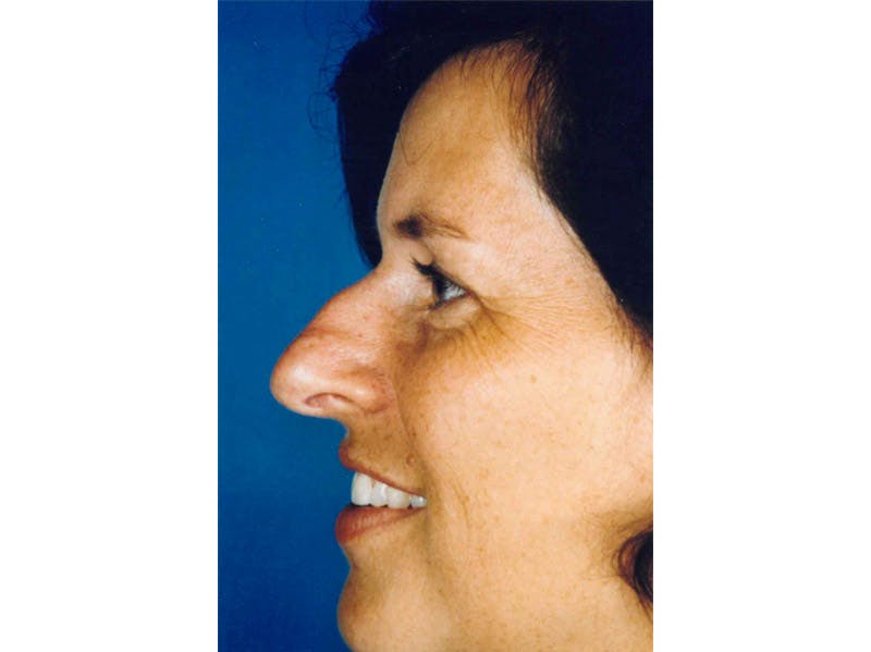 Rhinoplasty Before & After Gallery - Patient 133066762 - Image 1