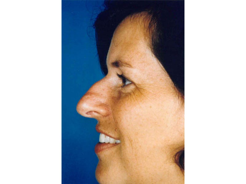 Rhinoplasty Before & After Gallery - Patient 133066762 - Image 1