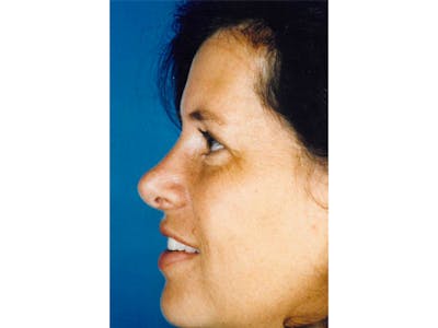 Rhinoplasty Before & After Gallery - Patient 133066762 - Image 2