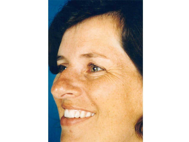 Rhinoplasty Before & After Gallery - Patient 133066762 - Image 3