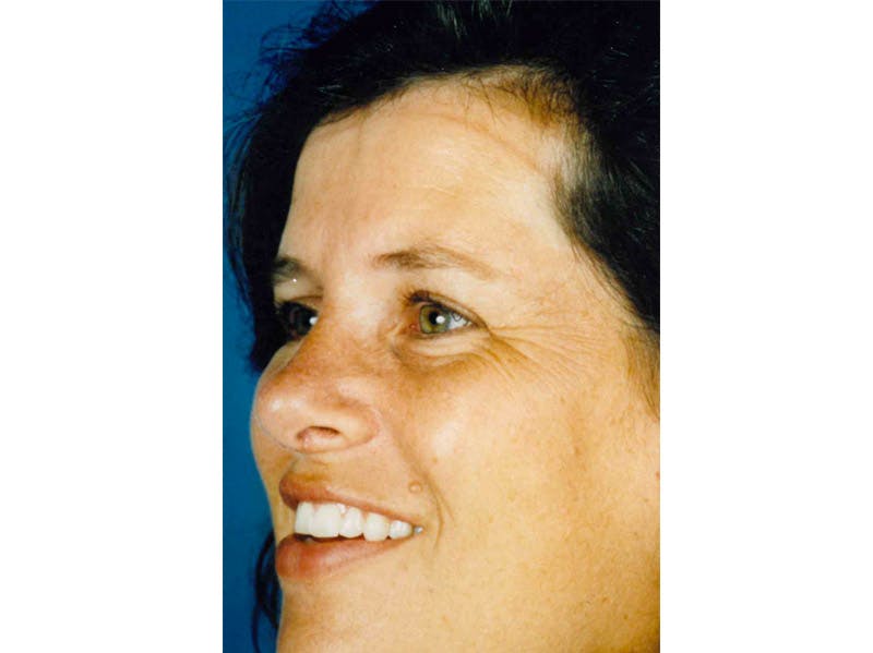 Rhinoplasty Before & After Gallery - Patient 133066762 - Image 4