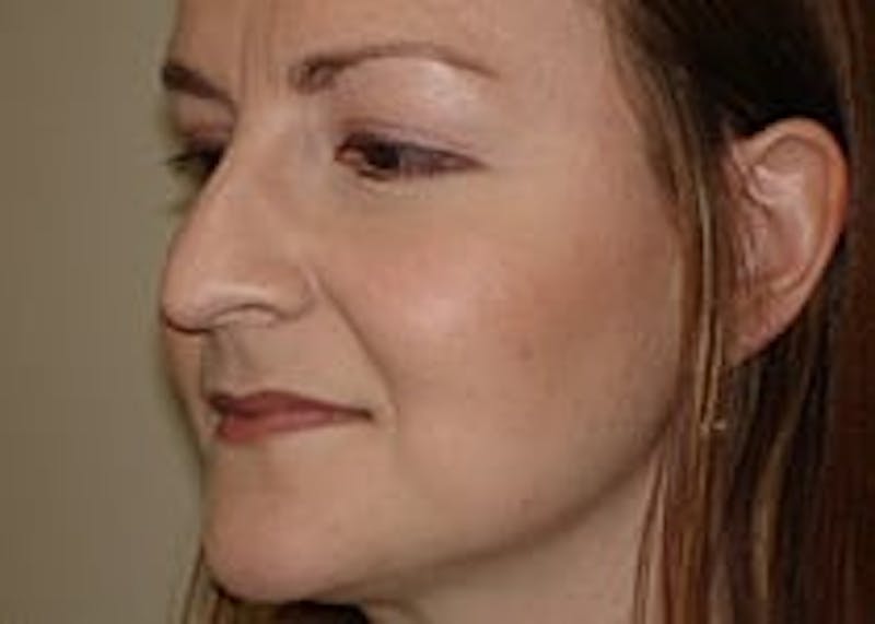 Rhinoplasty Before & After Gallery - Patient 133066763 - Image 1
