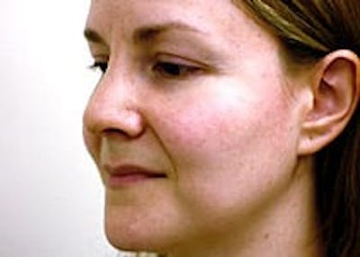 Rhinoplasty Before & After Gallery - Patient 133066763 - Image 2