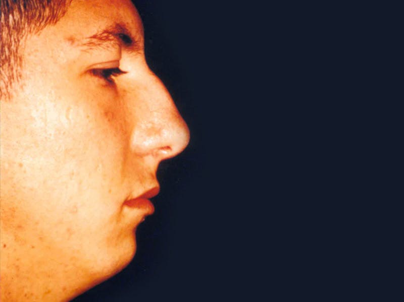 Rhinoplasty Before & After Gallery - Patient 133066764 - Image 1