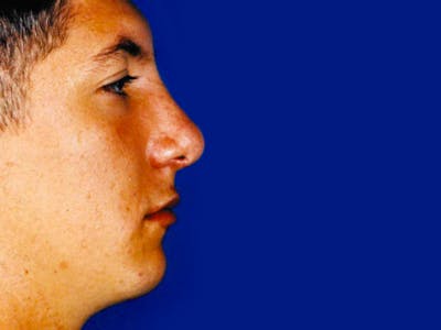 Rhinoplasty Before & After Gallery - Patient 133066764 - Image 2