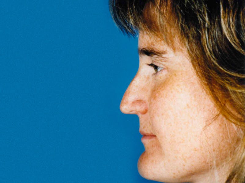 Rhinoplasty Before & After Gallery - Patient 133066765 - Image 1