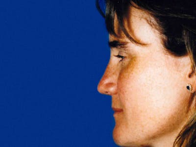 Rhinoplasty Before & After Gallery - Patient 133066765 - Image 2