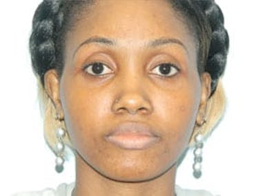 Rhinoplasty Before & After Gallery - Patient 133066773 - Image 1