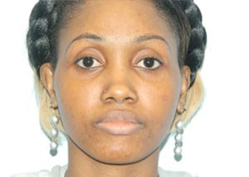 Rhinoplasty Before & After Gallery - Patient 133066773 - Image 1