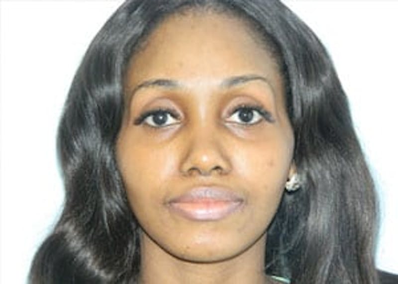 Rhinoplasty Before & After Gallery - Patient 133066773 - Image 2