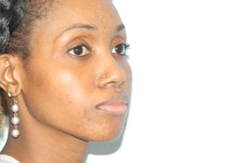 Rhinoplasty Before & After Gallery - Patient 133066773 - Image 3