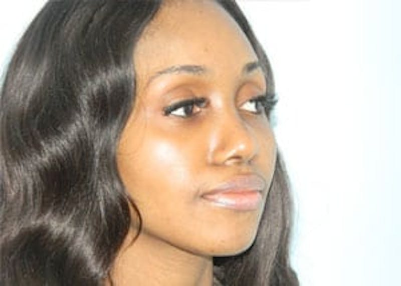 Rhinoplasty Before & After Gallery - Patient 133066773 - Image 4