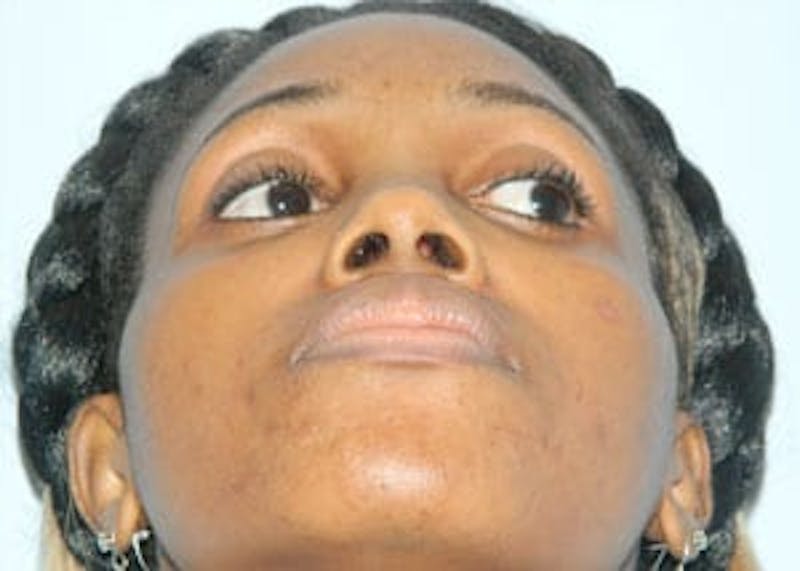 Rhinoplasty Before & After Gallery - Patient 133066773 - Image 5