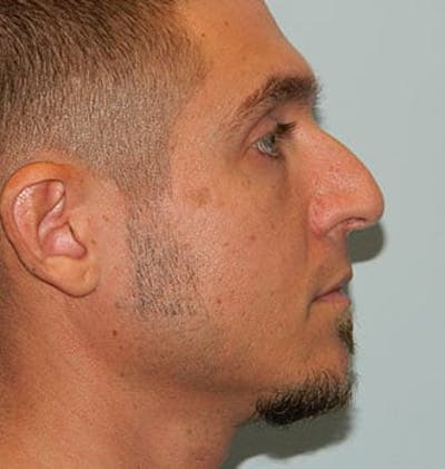 Rhinoplasty Before & After Gallery - Patient 133066775 - Image 1