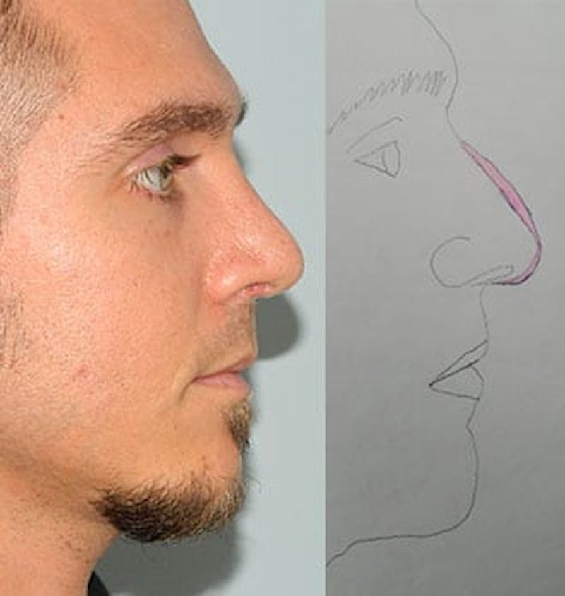 Rhinoplasty Before & After Gallery - Patient 133066775 - Image 2