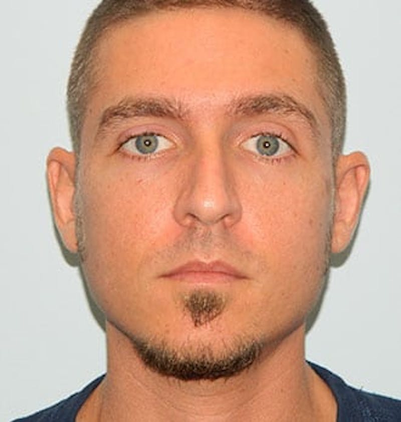 Rhinoplasty Before & After Gallery - Patient 133066775 - Image 3