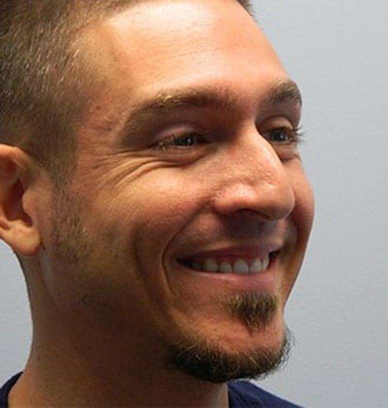 Rhinoplasty Before & After Gallery - Patient 133066775 - Image 5
