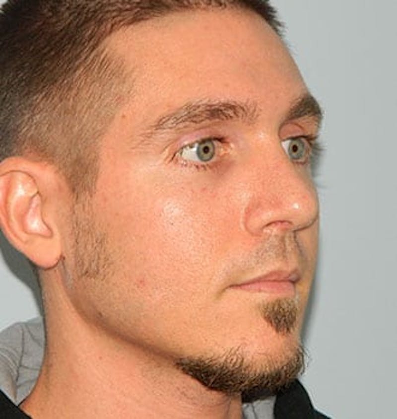 Rhinoplasty Before & After Gallery - Patient 133066775 - Image 6