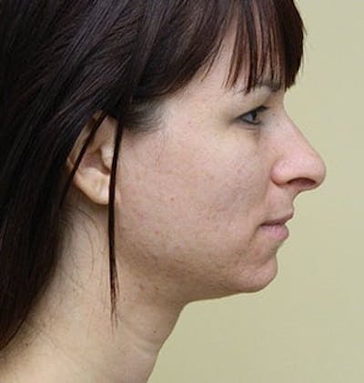 Rhinoplasty Before & After Gallery - Patient 133066778 - Image 1