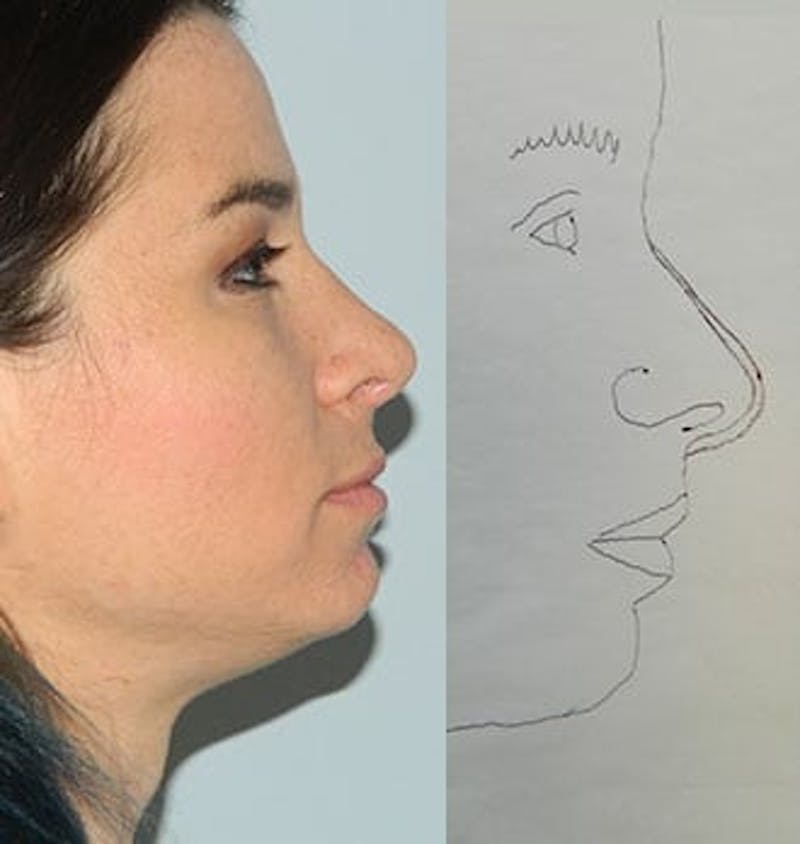 Rhinoplasty Before & After Gallery - Patient 133066778 - Image 2