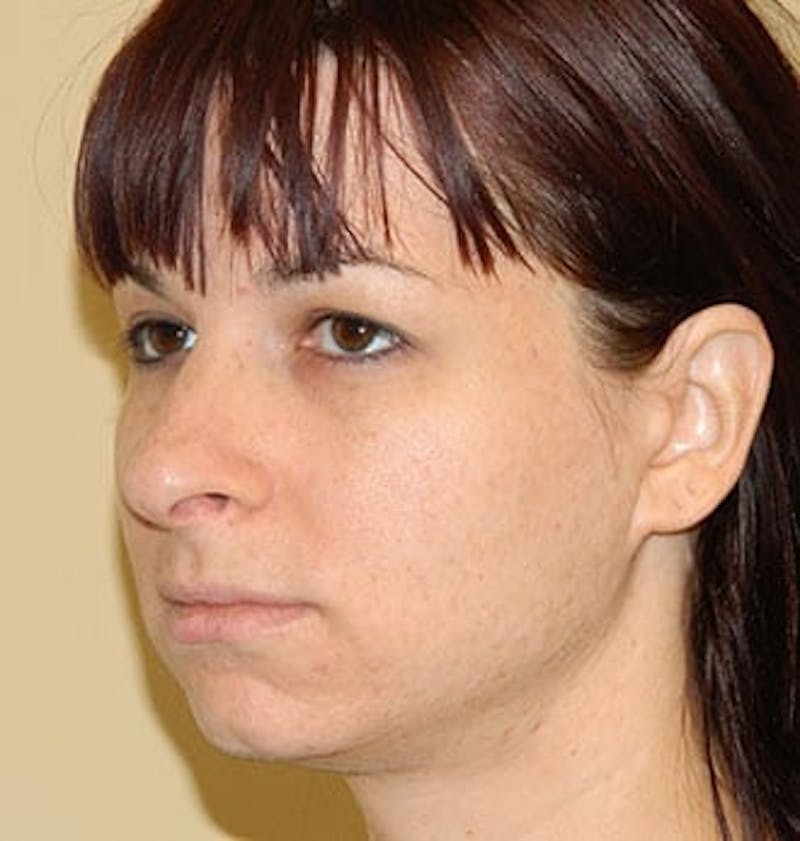 Rhinoplasty Before & After Gallery - Patient 133066778 - Image 3