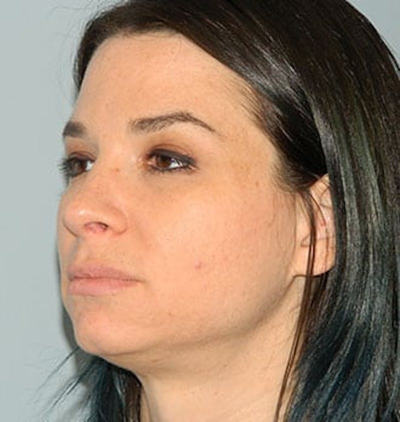 Rhinoplasty Before & After Gallery - Patient 133066778 - Image 4